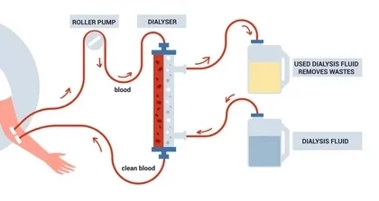 ডায়ালাইসিস কি